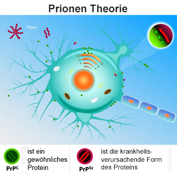 Neurologen gehen davon aus, dass die Creutzfeld-Jakob-Krankheit durch Prionen verursacht wird