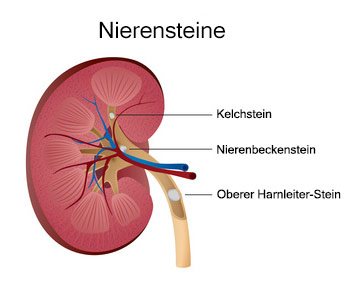 Nierensteine, Harnsteine (Nephrolithiasis)