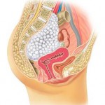 Bild 1: Querschnitt durch das weibliche Becken. Lage des Tumors vorderseitig der Wirbelsäule mit beginnender Kompression von Nerven, Dickdarm, Gebärmutter und Blase.ip