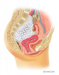 Bild 1: Querschnitt durch das weibliche Becken. Lage des Tumors vorderseitig der Wirbelsäule mit beginnender Kompression von Nerven, Dickdarm, Gebärmutter und Blase.ip