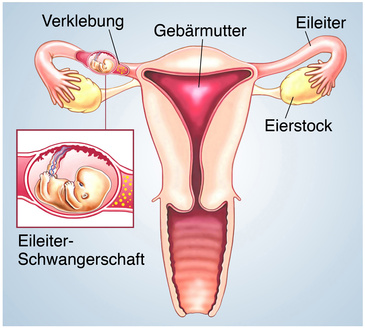 Darstellung einer Eileiterschwangerschaft
