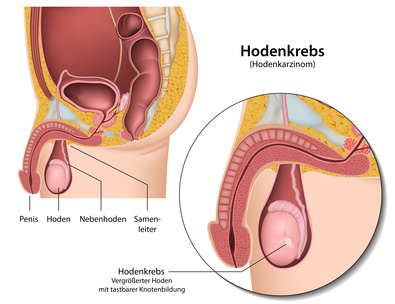 Unter Hodenkarzinom verstehen Urologen eine bösartige Wucherung im Hoden