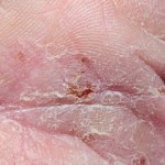 Die Haut bei Neurodermitis ist sehr trocken, schuppig, gerötet und zum Teil entzündet