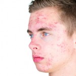 Akne vulgaris tritt oft bei Jugendlichen in der Pubertät auf