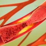 Ablagerung und Verengung einer Arterie - Arteriosklerose