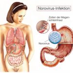 Noro-Viren sind noch Tage nach Abklingen der Magen-Darm--Infektion ansteckend