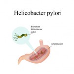 Häufig ist das Bakterium Helicobacter Pylori Auslöser des Ulkus