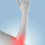 Orthopäden empfehlen den verletzten Muskel zu kühlen