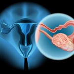Eierstockkrebs ist die zweithäufigste Krebserkrankung der weiblichen Genitalorgane